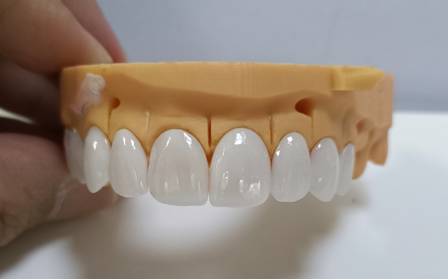 উচ্চ নন্দনতাত্ত্বিক Emax Veneers