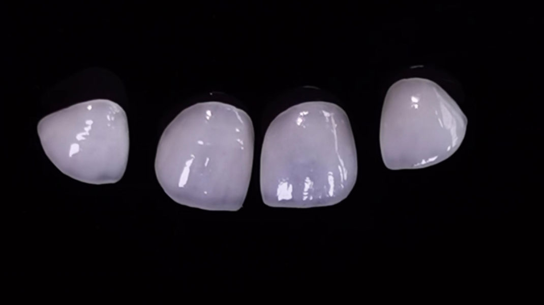 ডেন্টাল ল্যামিনেট ভেনিয়ার্স