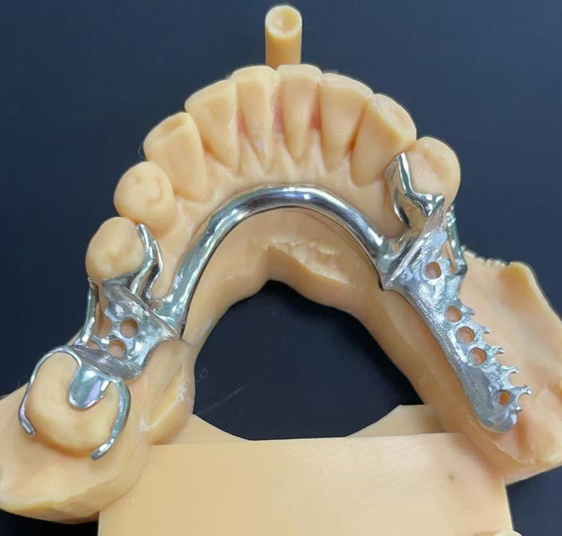 কোবাল্ট-ক্রোমিয়াম ফ্রেমওয়ার্কের সুবিধা (Co Cr Framework)