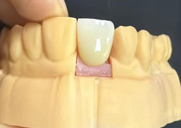 দাঁতের মধ্যে ফাঁক স্থির করা যেতে পারে - সোজা দাঁত সবচেয়ে আকর্ষণীয়!