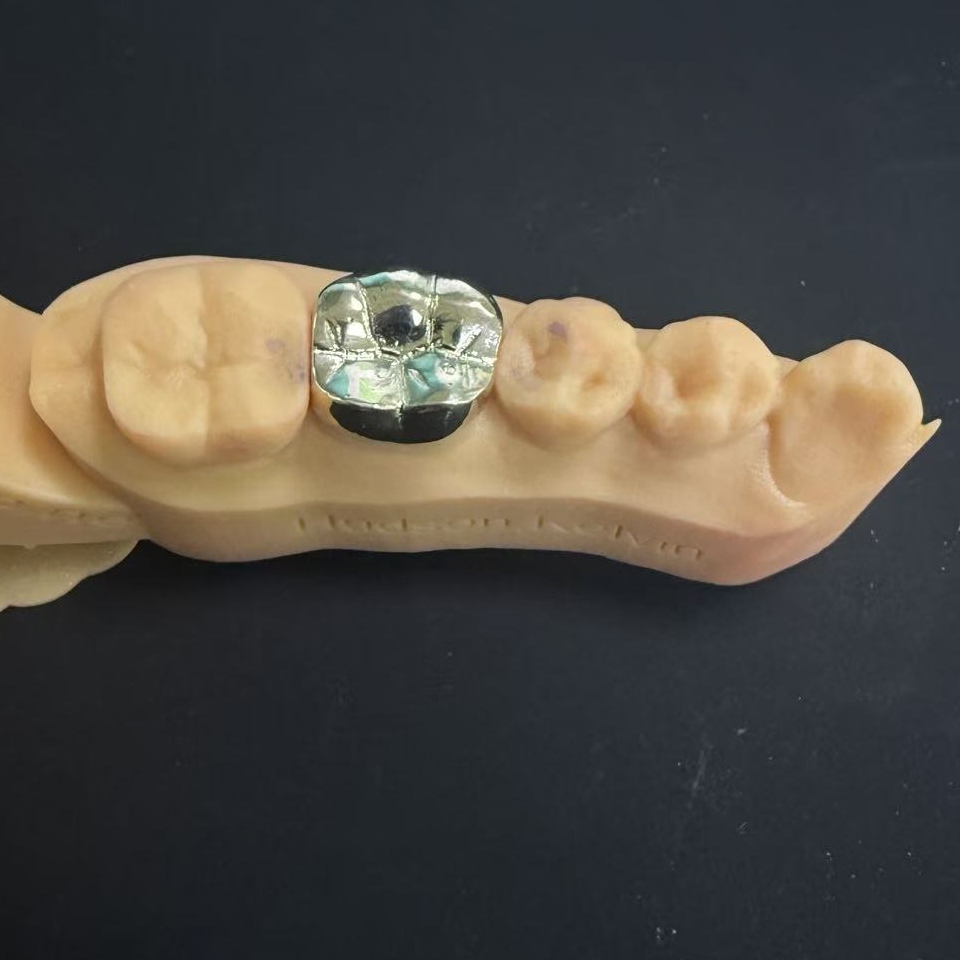 সোনার মুকুট: আজীবন দাঁতের পুনরুদ্ধারের জন্য মূল্যবান ধাতু পছন্দ