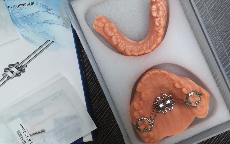 WM ডেন্টাল ল্যাবের সাথে MSE কঙ্কাল সম্প্রসারণ বুঝুন