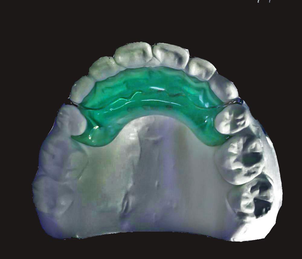 অগ্রবর্তী কামড় সমতল